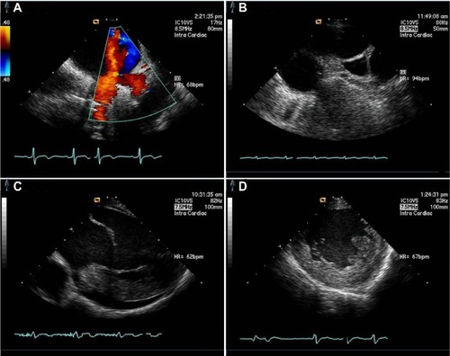 Figure 5 Real-time acquisition by intracardiac echocardiography.