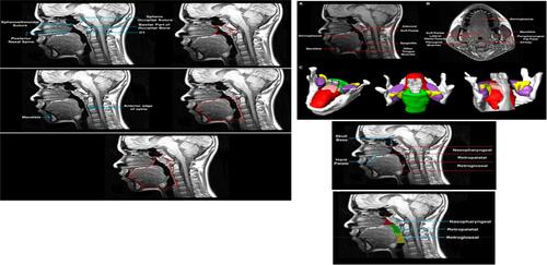 Figure S14 Anatomical definitions of upper airway landmarks on midsaggital and axial slices with 3D reconstruction of regions of interest.Note: Reprinted with permission of the American Thoracic Society. Copyright © 2020 American Thoracic Society. Schwab RJ, Kim C, Bagchi S, Keenan BT, Comyn FL, Wang S et al. 2015. Understanding the anatomic basis for obstructive sleep apnea syndrome in adolescents. Am J Resp Crit Care Med. 191. 1295-1309. Official journal of the American Thoracic Society.Citation147