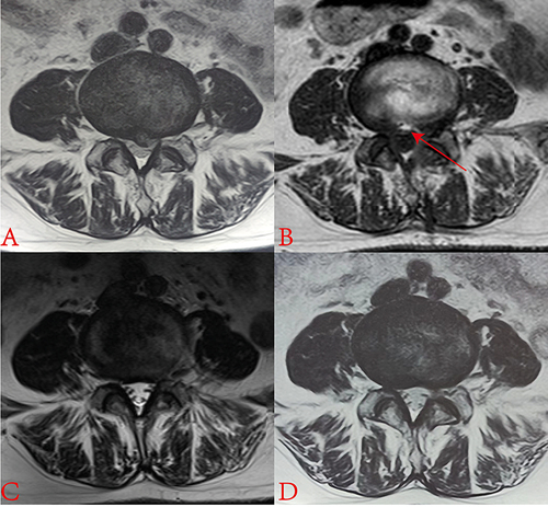 Figure 4 Preoperative, 1 h, 6-month, and 12-month postoperative MRI scans of patient 2. (A) Preoperative T2 weight scan displays a paramedian disc herniation in L4-L5. (B) The postoperative T1 weight scan with the red arrow pointing to the annulus fibrosus rupture. (C and D) Postoperative T2 weight scans at 6 months and 12 months, respectively, show that the remodeling of annulus fibrosus has occurred in the operated segment.