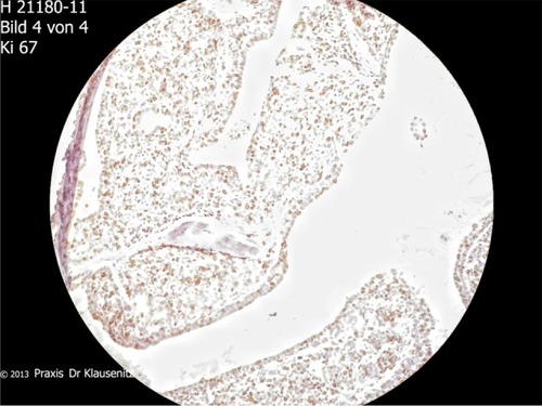 Figure 6 High proliferation activity in areas of solid tumor, Ki67 index 20%.