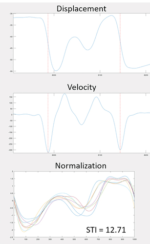 Figure 1. Example of the kinematic data extraction. The top and middle panels show the lower lip displacement and velocity, respectively, from a child with PD producing [mɑdɑbɑ] in session 1. The bottom panel shows seven normalised productions and the associated STI.