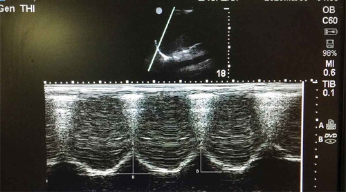 Figure 1. M-mode ultrasonography of diaphragmatic excursion. A: primary position of diaphragm at end of expiration; b: secondary position at end of inspiration. The amplitude of excursion (white line) was measured on vertical axis of the tracing from A B.