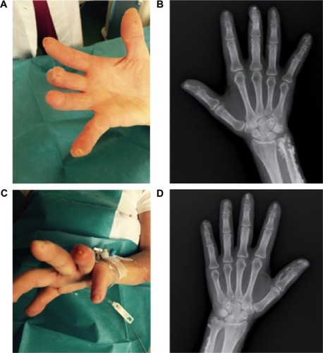 Figure 1 Digital ulcers of the third and fifth fingertips of the right hand (A) and the fourth fingertip of the left hand (C) at baseline. The underlying calcinosis is shown in the plain X-ray images of the right (B) and left (D) hands.