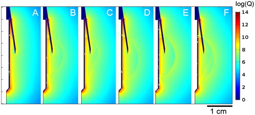 Figure 4. Joule heat distribution in the tissue for cases A–F at 1 s of ablation, (logarithmic scale in W/m3). Note that maximum values are reached only on the electrode surface and the infusion needles.