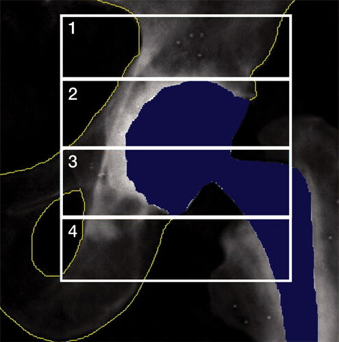 Figure 3. Wilkinson regions of interest (ROI) 1–4. Only the bone areas within yellow lines are included in the analysis.