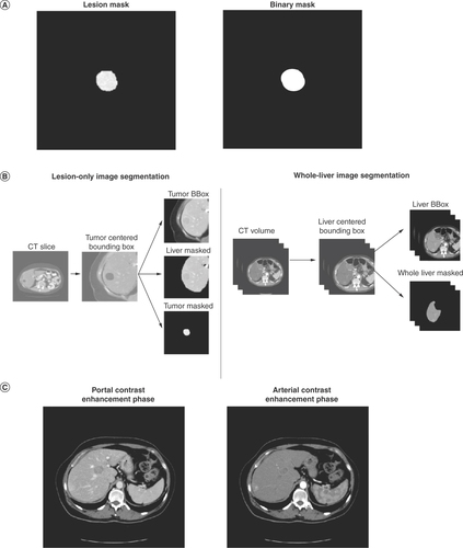 Figure 3. CT scans of liver images utilized in RAISE.Deep learning model performance was compared using various CT liver image inputs. (A) Application of a binary mask and lesion mask to CT liver images. The binary mask represents the contour of the lesion (with all pixels within the lesion boundary set to 1 and all the pixels outside the lesion boundary set to 0). A lesion mask represents the entirety of the lesion (with all pixels outside of the lesion’s contour set to 0). (B) Segmentation of lesion-only and whole-liver image inputs. (C) Liver CT images obtained in the portal and arterial contrast enhancement phases.CT: Computerized tomography