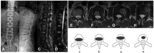 Figure 1 53-year-old male with esophageal cancer. (A and B) Preoperative X-ray showed bone destruction at L1~L4; (C and D) Preoperative MRI showed multiple spine metastases (L1~L4); (E) MRI showed transversal spine metastases at L1, and it had deformation of the dural sac, but without spinal cord or nerve root compression; (F) MRI showed transversal spine metastases at L2, and it had epidural impingement, but without deformation of the dural sac; (G) MRI showed transversal spine metastases at L3, and it had complete posterior wall; (H) MRI showed transversal spine metastases at L4, and it had complete posterior wall. The pattern diagrams were shown just below the transversal MRI image of L1 to L4. It indicated that L1 was classified into group C, L2 was classified into group B, and L3 and L4 were classified into group A. And the patient was classified into group C.