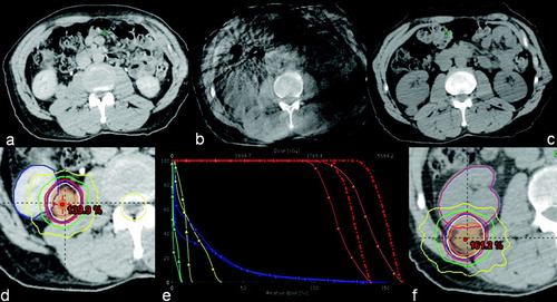 Figure 1.  Tumor position at simulation, at image-guidance and in the re-simulation CT including original plan dose and re-simulation dose reconstruction, as well as a comparison DVH. PTV is orange-colored, GTV is red, right kidney is blue and spinal is cord yellow The lines with square markings denote the original plan, while the lines with triangles represent the original plan on the re-simulation CT.