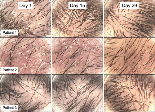 Figure 3 Microscopic analysis of the scalp, showing scalps from the three participants with the highest amount of change (reduction on redness, dandruff and dryness).