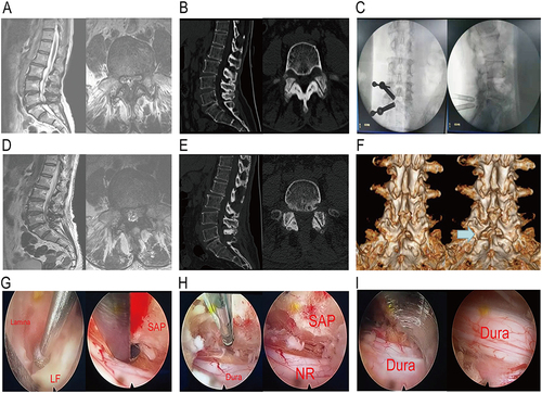 Figure 5 A 58-years-old female patient was troubled by sensory numbness of both lower limbs and diagnosed with bilateral lateral recess spinal canal stenosis at the level of L4-5. (A and D) Preoperative MRI scan revealed that dura were compressed bilaterally at the level of L4-5. Postoperative MRI scan showed spinal canal was enlarged and the dural sac dilated. (B) Preoperative CT scan of the level of L4-5 showed the bilateral narrow lateral recess caused by hyperplastic superior articular process (SAP). (E) Postoperative CT scan presented the decompression of spinal canal and bilateral lateral recess. (C) Intraoperative radiography of placement of working cannulas.(F) Postoperative CT scan presented that central part of lamina were removed and bilateral nerve root canals were widened. Preoperative and postoperative lamina were compared through three-dimensions CT reconstruction. (G) High-speed grinding drill and spinal endoscopic Kerrison punch were cooperated to remove the lamina and ligamentum flavum (LF). (H) The contralateral nerve root (NR) were decompressed completely and the nerve root canal were enlarged. (I) The endoscopic overview of dura and ipsilateral and bilateral nerve root.