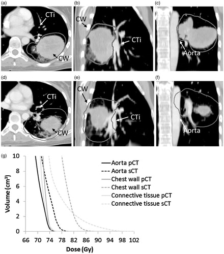 Figure 4. The largest tumour shrinkage observed in this study (101.6 cm3). Panel (a)–(c): Tumour at pCT. Panel (d)–(f): tumour at sCT. The 74 Gy isodose (dark gray), the aorta, the chest wall (CW) and the CTi are shown. Panel (g) The corresponding DVH’s for aorta, chest wall and CTi on pCT(full line) and sCT (dashed line).