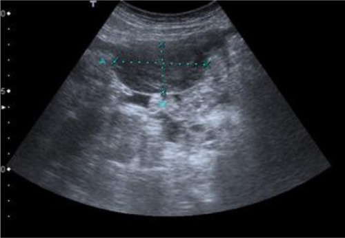 Figure 8 Abdomen ultrasonography showing a mass with 58 × 30 mm in the left parietocolic groove.