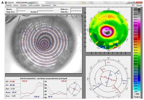 Figure 2 (A) Videokeratographic map of the right eye of a 19-year-old male patient before treatment. The topographic pattern highlights the keratoconus appearance. The apex of ectasia power (in the central side of the cornea) is 68.7 D (relative scale, tangential algorithm). (B) Right eye videokeratographic map 12 months after transepithelial corneal collagen cross-linking with riboflavin and ultraviolet A irradiation.