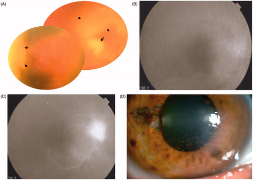 Figure 1. (A) Fundus photograph of the right eye shows 2+ vitreous haze, central and peripheral necrotizing retinitis (arrows), retinal opacification in the posterior pole (arrowheads) as well as narrowing and sheathing of retinal vessels. (B) Early phase fluorescein angiography image of the right eye reveals delay in arterial filling (C) Late phase fluorescein angiography image of the right eye reveals impaired arterial and venous filling, as well as late diffuse leakage from the optic disc. (D) Anterior segment photograph of the same eye five months after the resolution of acute retinal necrosis, shows disciform keratitis, granulomatous precipitates and sectorial iris atrophy.