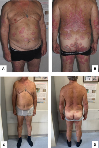 Figure 1 (A and B) Moderate-to-severe psoriasis, with a Psoriasis Area and Severity Index (PASI) score of 16, body surface area (BSA) score of 12 and Dermatology Life Quality Index (DLQI) score of 18 prior to treatment with biological therapy. (C and D) Complete clinical response after 16 weeks of secukinumab.