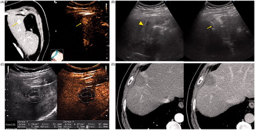 Figure 3. A 79-year-old man with a history of cirrhosis and hepatitis C and prior treatment with surgery and radiofrequency ablation for HCC. (A) CECT (left) and CEUS (right) images demonstrating an arterially enhanced liver lesion (yellow arrows). (B) Ultrasound image showing single gas cooled-antenna (arrowhead) being guided into the HCC (left) and after being treated at 50 W for 5 min (right). This ultrasound image shows progression of treatment via rapid generation of gas inside the liver tissue (arrow). (C) On post-procedural B-mode (left) and CEUS (right) (24 h post-ablation), the image shows presence of a central hypo-echoic area corresponding to the lesion treated, surrounded by a hyper-echoic area which corresponds to the inflammatory region of the ablation zone. (D) A 24-h post-ablation arterial phase CECT (left) and portal-venous phase CECT (right) showing the ablation zone encompassing the lesion (arrows).