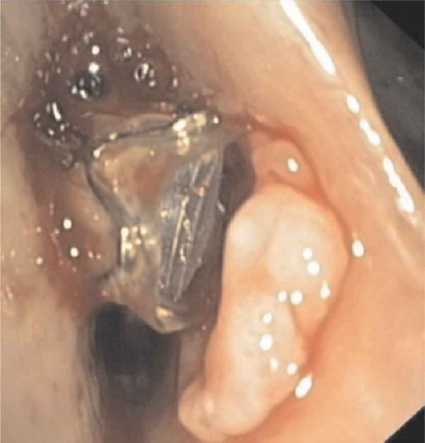 Figure 10. Airway ulceration due to contact of the valve with the opposite airway wall which led to hemoptysis. In this case valve removal was sufficient to treat the hemoptysis