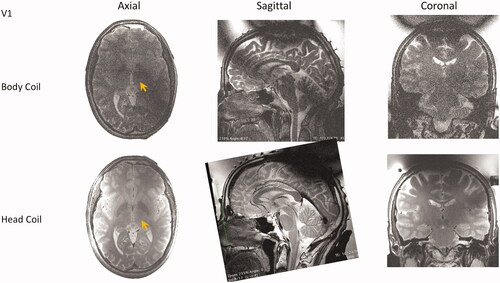 Figure 5. Comparison of image quality of T2wFSE treatment planning images in one volunteer without and with the tcMRgFUS head coil in the transducer water bath treatment setup. Head coil images provide greater detail of the thalamus, globus pallidus and subthalamic nucleus on axial images (orange arrows), and the anterior/posterior commissure (AC/PC), brain stem, and cerebellum on sagittal images.