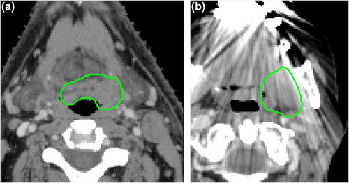 Figure 1. Representative images of OPSCC patients from the validation cohort, without (a) and with (b) visible CT artifacts. The GTV delineation is shown in green.