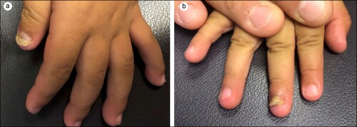 Figure 2. Onychomadesis, a sequela of Kawasaki disease. (a) Left first digit. (b) Right third digit.
