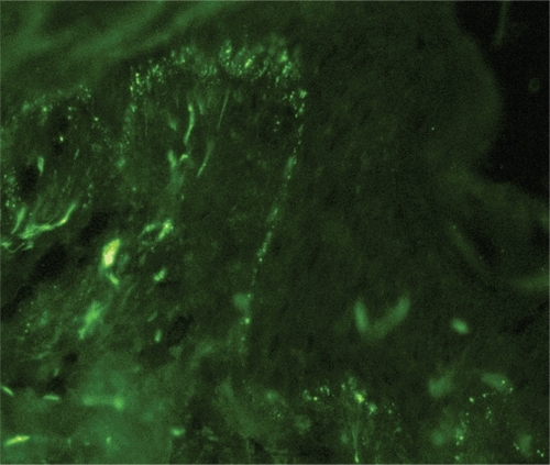 Figure 4 Stippled pattern of complement component 3 deposits in sun-protected nonlesional skin in patient with systemic lupus erythematosus (original magnification: ×400).