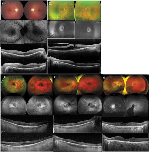 Figure 4. Spectrum of disease severity in patients with CNGB1-associated RP. Color fundus imaging (top row), fundus autofluorescence (2nd row) and right and left eye SD-OCT (bottom 2 rows) images, respectively for patient B1 (a) from family 2; patient F1 (b) from family 6; patients G1 (c) and G2 (d) from family 7; and (e) patient H1 from family 8, illustrating typical presentations of RP features (b–e) waxy pallor of the optic disc, severe attenuation of the retinal vasculature, RPE breakdown, and bone-spicule pigment clumping in the mid-periphery. (b and e) Cystoid macular edema (CME) and (a–c) epiretinal membrane. A macular hole is evident for patient F1 (B)