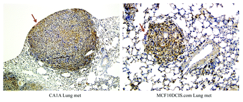 Figure 3. Cullin-3 is overexpressed in lung tumors of breast cancer cells. MCF10CA1A and MCF10DCIS.com cells were injected via tail vein into nude mice. Lung tumors, as indicated by arrows, were formed, excised and stained for Cullin-3 protein by IHC (x20).