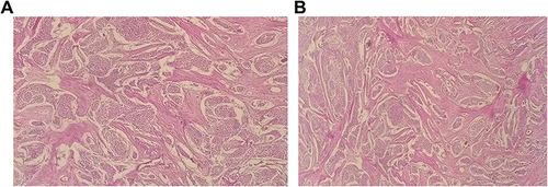 Figure 7 (A and B) Microscopic picture on 10/HPF showing thickened lamellar and woven bone cuffing whorl and syncytium of oval to spindle meningothelial cells.