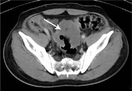 Figure 1 Computed tomography scan of 52-year-old man with mucinous carcinoma in rectum.