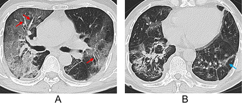 Figure 5 A 60-year-old male patient infected with the original strain. (A and B) Axial computed tomography (CT) images show linear opacities (blue arrow) and multiple subpleural ground-glass opacities (GGOs) in both lungs with a vascular enlargement pattern (red arrow).