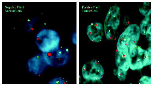 Figure 3. FISH results showing polysomy of chromosome 3 (red) in the tumor cells. Some normal cells were identified in the resected tissue and they were negative for chromosome 3 polysomy on FISH analysis.