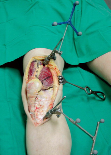 Figure 1. Experimental set-up. The two reference arrays are rigidly attached to the femur and the tibia.