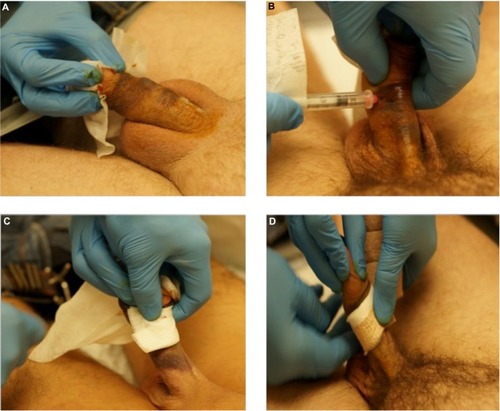 Figure 2 Administering CCH injections for Peyronie’s Disease with evident bruising as a common side effect.