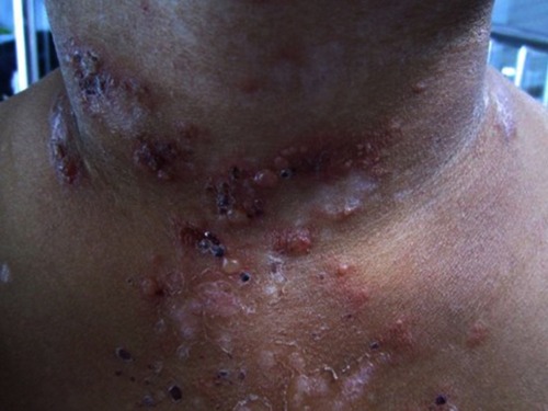 Figure 6 A 12-year-old Thai female diagnosed with bullous systemic lupus erythematosus. Multiple tense vesicles, bullae, and crusts on erythematous edematous patches and plaques in a V shape on the neck. Some lesions healed with postinflammatory hypopigmentation.