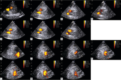 Figure 6. Doppler ultrasound images of both volunteers. (A) Pulsed-color Doppler ultrasonography of the right iliac vessels the day of the surface scanning for the first volunteer. (H) Pulsed-color Doppler ultrasonography of the right iliac vessels the day of the surface scanning for the for the second volunteer. (B–G) Serial acquisition after the volunteer repositioning in the immobilization device for the first volunteer. (I–N) Serial acquisition after the volunteer repositioning in the immobilization device for the second volunteer. A scale distance is provided left side, graduated in cm.