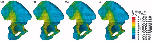 Figure 5. The stress distribution in the iliac bone under different femur rotation angles with no fixation systems under 600N static vertical loads. (A) 0°, (B) 5°, (C) 10°, (D) 15°.