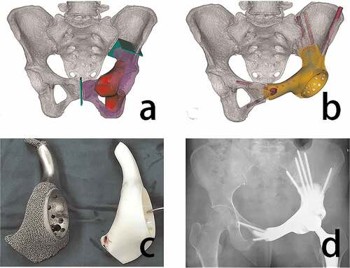 Figure 2. Design, production, and application of 3D printed prosthesis after hip tumor resection (a) osteotomy (green) was simulated on the pelvis model (white), the excised specimen was purple and the tumor was red. (b) the prosthesis was designed based on simulated surgical reconstruction of bone defects, the sacroiliac joint and a part of the pubis were preserved. (c) the endoprosthesis model and prosthesis are exhibited (d) the postoperative plain radiographs showed an accurate reconstruction using a 3D-printed prosthesis [Citation41]