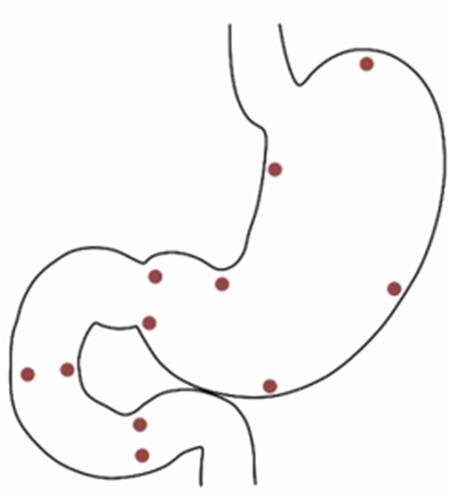 Figure 2 Measurement points in the stomach and duodenum in the study of perioperative microcirculatory changes in patients with MALS.Abbreviation: MALS, median arcuate ligament syndrome.