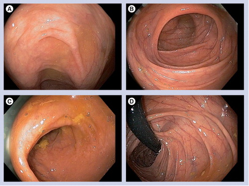 Figure 3. Photodocumentation of the right colon.(A) Appendiceal orfice. (B) Ileocecal valve. (C) Terminal ileum. (D) Ascending colon in retroflexion.
