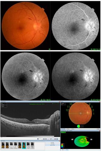 Figure 4 A case of AION (image on the upper part shows blurred disc margins in colour photo with hyperfluorescence leakage in early and late stages of F/A and image on the lower part shows OCT of the same case with edematous disc).