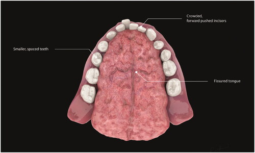 Figure 11. Reba (Rebekah) Sadok – Down Syndrome tongue 3D model.