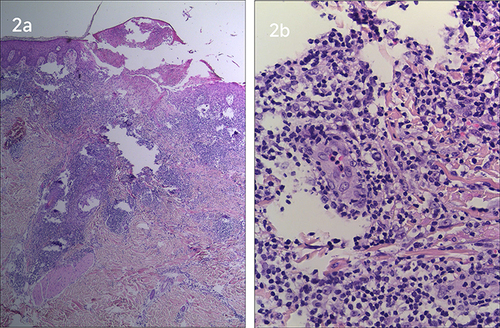 Figure 2 (a) HE staining*40; (b) HE staining*100, eosinophil and neutrophil infiltration be seen in the dermis and subcutis.