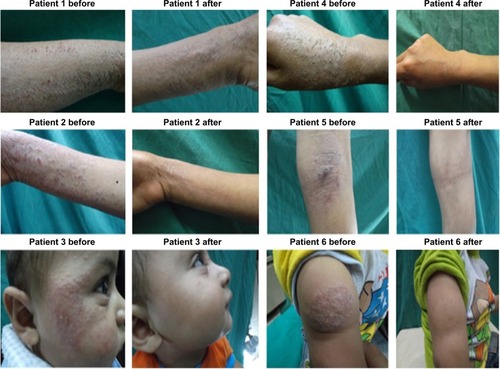 Figure 5 Photographs of different AD patients before and after treatment with silymarin loaded PLO gels.0