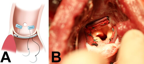 Figure 2. Figure 2A presents an illustration of how the annuloplasty ring sections are sewn to the aortic annulus. Figure 2B is a photograph of the newly created modified aortic annulus immediately after implant, as viewed from the left ventricle outflow tract.