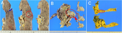 Figure 2 Gross findings of the autopsy. The tumors are shown inside the red circles. (A) Left lung. (B) Soft tissue, muscles, and carotid artery (arrowhead) of the left neck. (C) Mesentery.