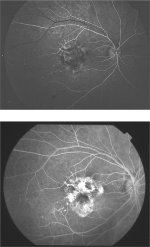 Figure 2 Case 6. Choroidal neovascularization without photodynamic therapy treatment. A) On presentation. B) At the end of 134-month follow-up period. There is an apparent increase of choroidal neovascularization.