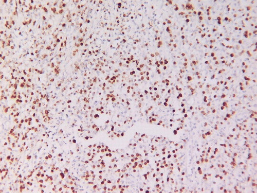Figure 4.  EBV in situ hybridization demonstrates positivity in the neoplastic large B-cells (original magnification×400).