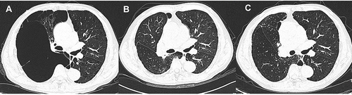 Figure 3 Chest CT scan images at baseline, 7 days and 3 months after the bronchoscopic silicone plug placement in Case 1. (A) A GEB occupying almost entirely the right upper lobe before treatment. (B) At 7 days after the procedure, a CT scan showed complete silicone plugs placement of the GEB and re-expansion of the adjacent lung. (C) The radiological improvement was sustained for 3 months after treatment.