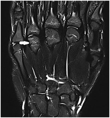 Figure 5. Third MRI January 2023. Apparition of signal abnormality of the fourth metacarpal head in the MRI T1 weighted images.