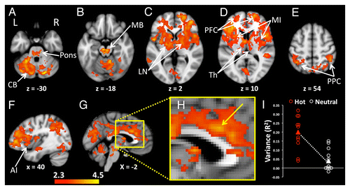 Figure 2. Increased levels of functional connectivity with the POA during heating compared with the neutral condition were seen in widely distributed regions of the brain. (A) The pons and bilateral regions of the cerebellum (CB) showed heating-related increases of POA connectivity. (B) Enhanced POA connectivity was also apparent in midbrain (MB), (C) lentiform nuclei (LN), (D) bilateral thalamus (Th), mid insula (MI), prefrontal cortices (PFC), (E) and bilateral posterior parietal cortices (PPC). (F) The anterior insula (AI) in the right hemisphere showed heating-related increases in connectivity with the POA. (G) Mesial regions including the midcingulate cortex, posterior cingulate cortex and precuneus had increased POA connectivity during heating. (H) An enlarged image of the mesial surface of the brain shows the location of increased POA connectivity in the midcingulate cortex The arrow indicates the voxel with the highest statistic (z = 3.73) in the slice at x = –2, y = 18, z = 28. (I) Signals from the midcingulate region, shown in H, were extracted and correlated with the corresponding POA seeds in order to visualize the distribution of variances between the two groups of participants. Activations Pcorrected < 0.05. Background image is MNI template brain and axial slices are oriented to show right side of brain on right side of image. Positions of slices labeled according to convention where +ve z = distance in mm superior to anterior commissure, -ve z = distance in mm inferior to anterior commissure, +ve x = distance in mm to right of midline, -ve x = distance in mm to left of the midline. Axial images (A–E) are displayed with the right side of the brain on the right side of the image.